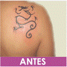eliminacion_de_tatuajes_antes